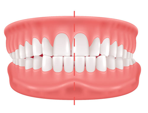 Crossbite (Misalignment)